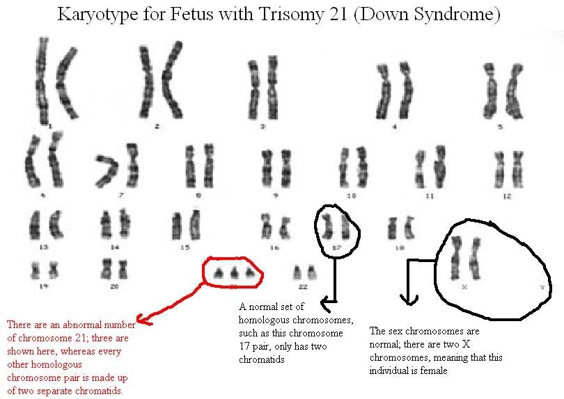 trisomy 21 photo: Karyotype with Trisomy 21 downsyndromekaryotype.jpg